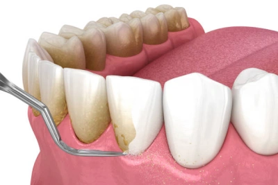 Reduction of Periodontal Pockets 